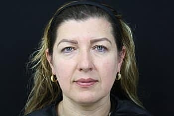 Dermal Fillers Before & After