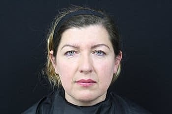 Dermal Fillers Before & After