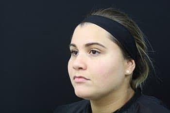 Dermal Fillers Before & After