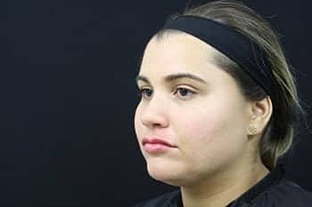 Dermal Fillers Before & After