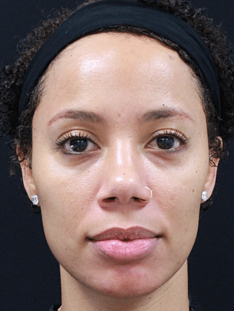 Dermal Fillers Before & After