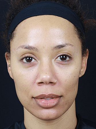 Dermal Fillers Before & After