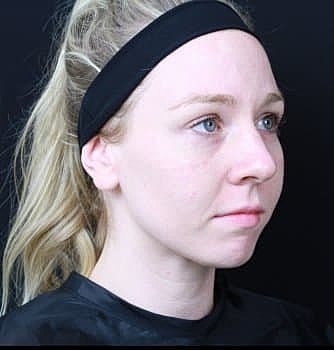 Dermal Fillers Before & After