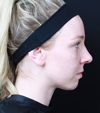 Dermal Fillers Before & After