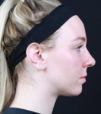 Dermal Fillers Before & After