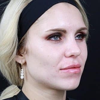 Dermal Fillers Before & After