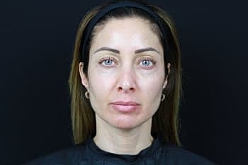 Dermal Fillers Before & After