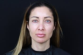 Dermal Fillers Before & After