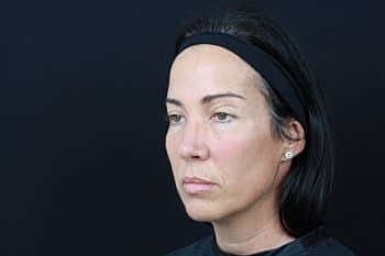 Dermal Fillers Before & After