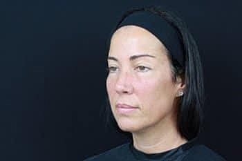 Dermal Fillers Before & After