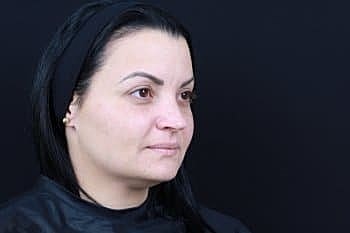 Dermal Fillers Before & After
