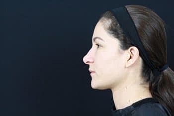 Dermal Fillers Before & After