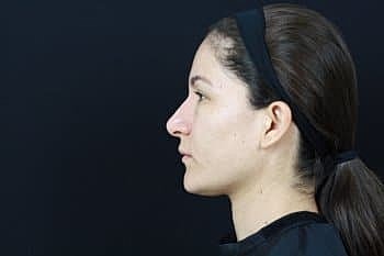 Dermal Fillers Before & After