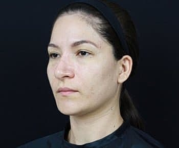 Dermal Fillers Before & After