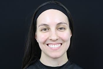 Dermal Fillers Before & After
