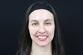 Dermal Fillers Before & After