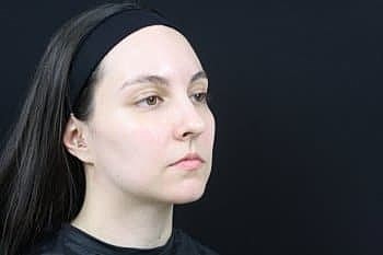 Dermal Fillers Before & After