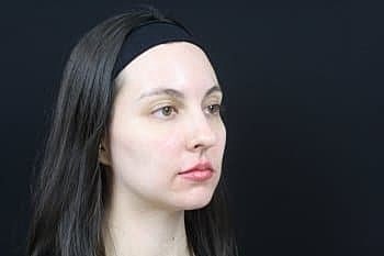 Dermal Fillers Before & After