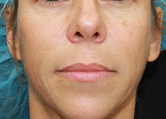Dermal Fillers Before & After