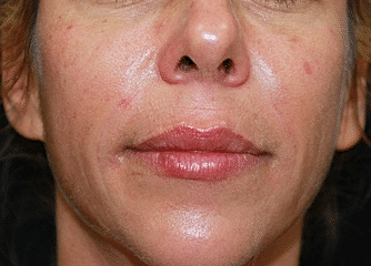 Dermal Fillers Before & After