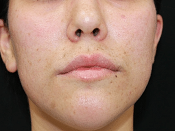 Dermal Fillers Before & After
