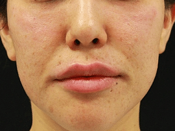 Dermal Fillers Before & After