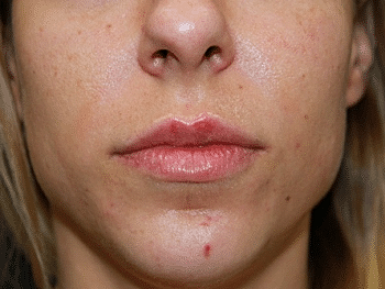 Dermal Fillers Before & After