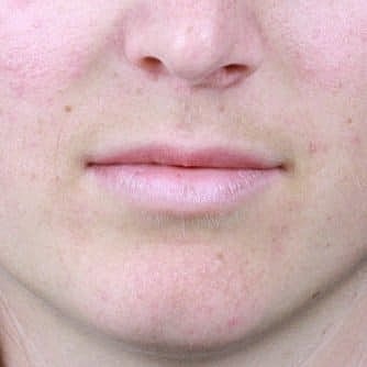 Dermal Fillers Before & After