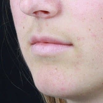 Dermal Fillers Before & After