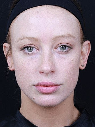 Dermal Fillers Before & After