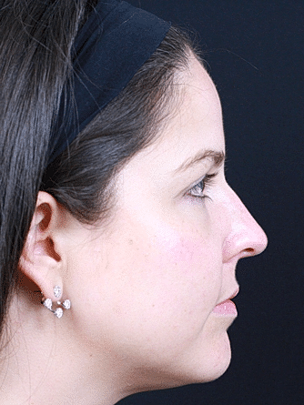 Dermal Fillers Before & After