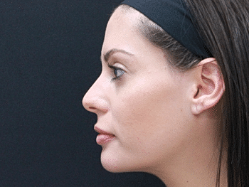 Dermal Fillers Before & After