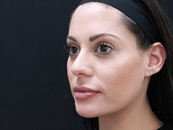 Dermal Fillers Before & After