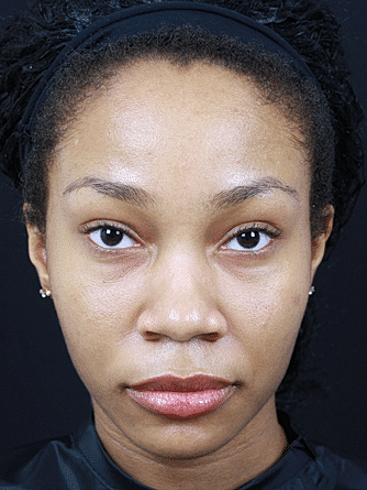 Dermal Fillers Before & After