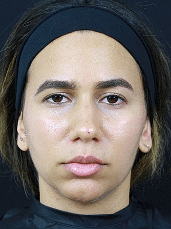 Dermal Fillers Before & After