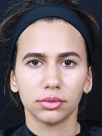 Dermal Fillers Before & After