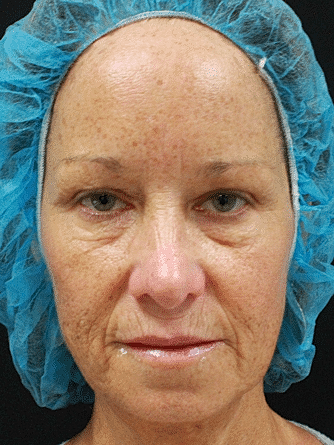 Dermal Fillers Before & After