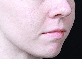 Dermal Fillers Before & After