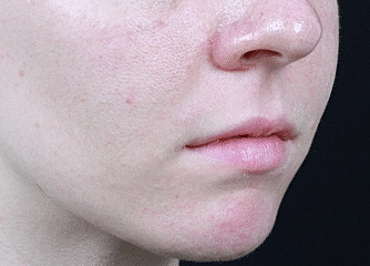 Dermal Fillers Before & After