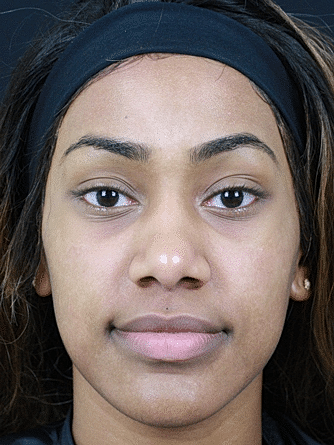 Dermal Fillers Before & After