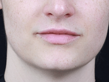 Dermal Fillers Before & After