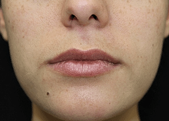 Dermal Fillers Before & After