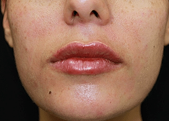 Dermal Fillers Before & After