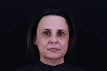 Botox & Dysport Before & After