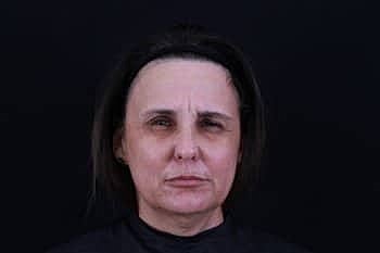 Botox & Dysport Before & After