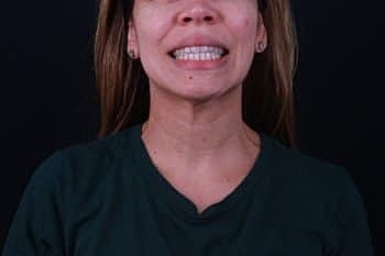 Botox & Dysport Before & After
