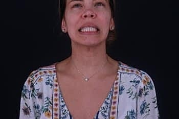 Botox & Dysport Before & After