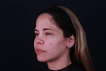 Botox & Dysport Before & After