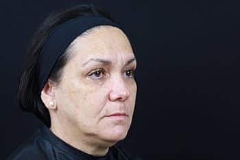 Botox & Dysport Before & After