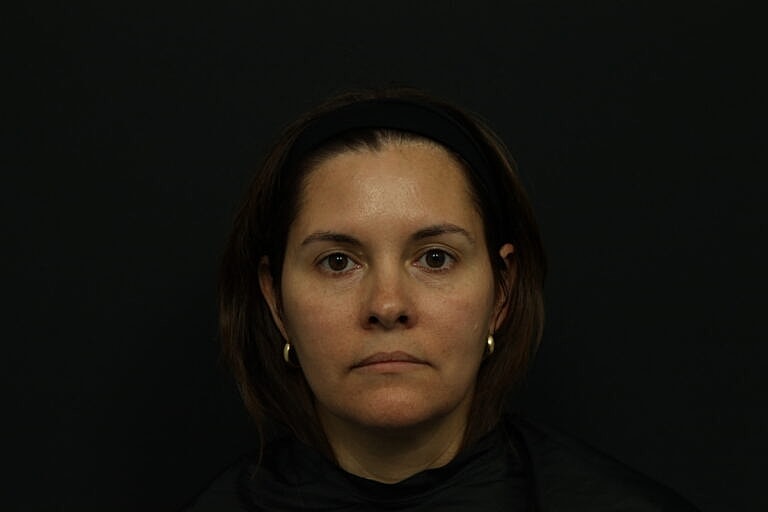 Botox & Dysport Before & After